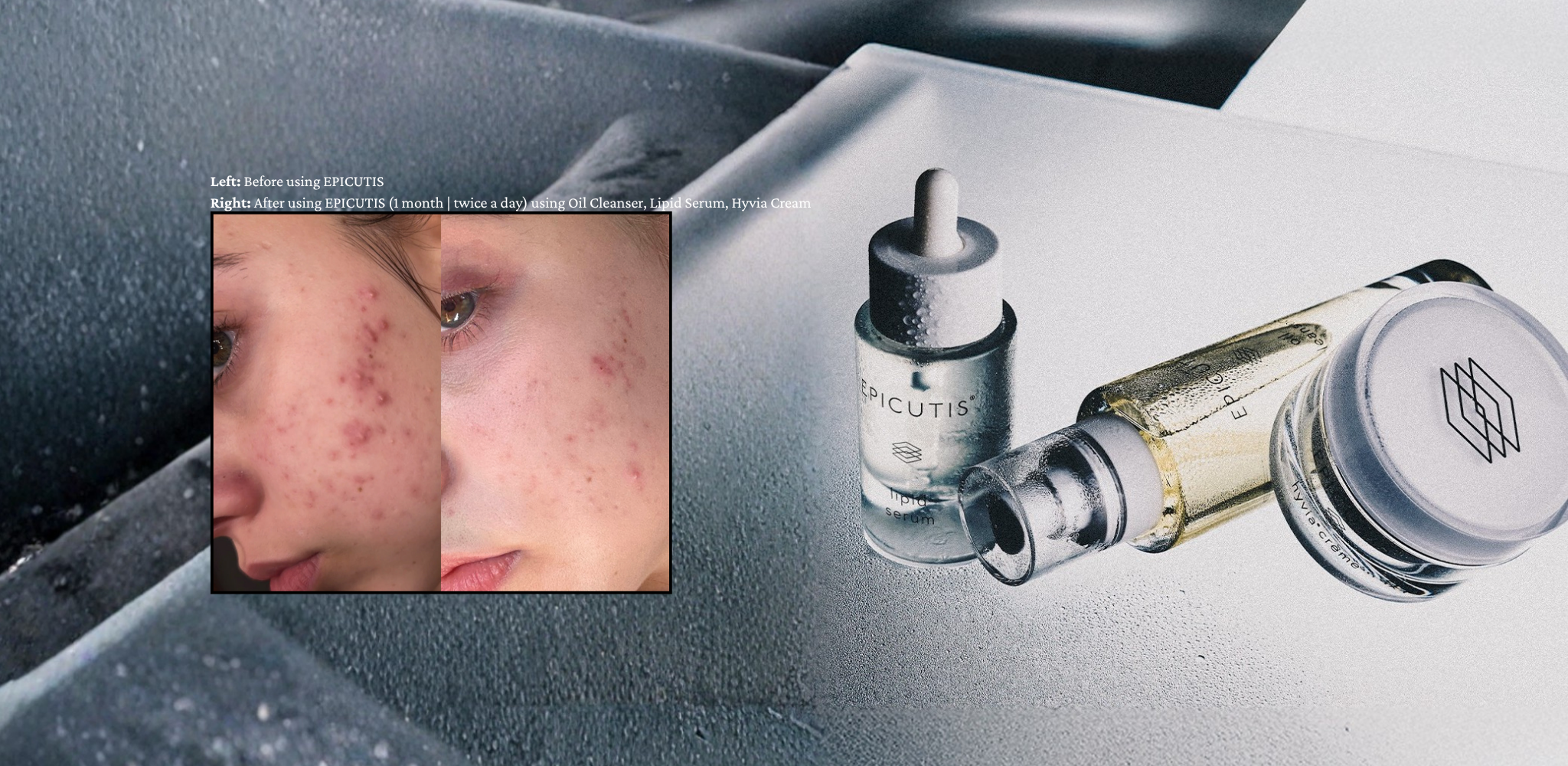 best acne skincare before and after reviews