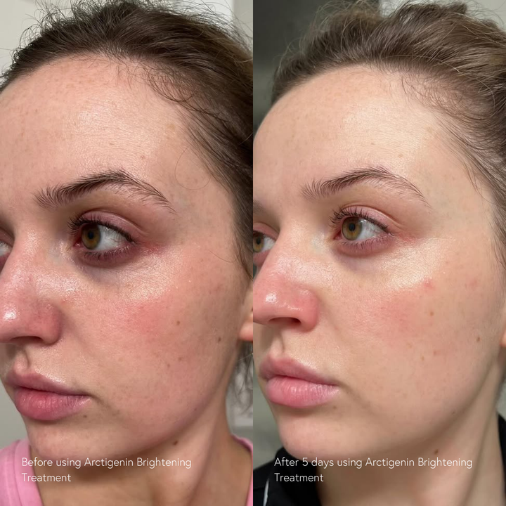 brightening treatment for rosacea