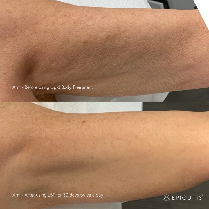 Comparison of arm skin before and after using Lipid Body Treatment by Epicutis.