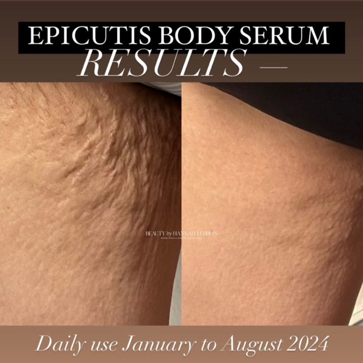 Epicutis before and after lipid body lift serum