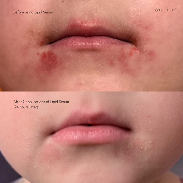 Epicutis lipid serum before and after