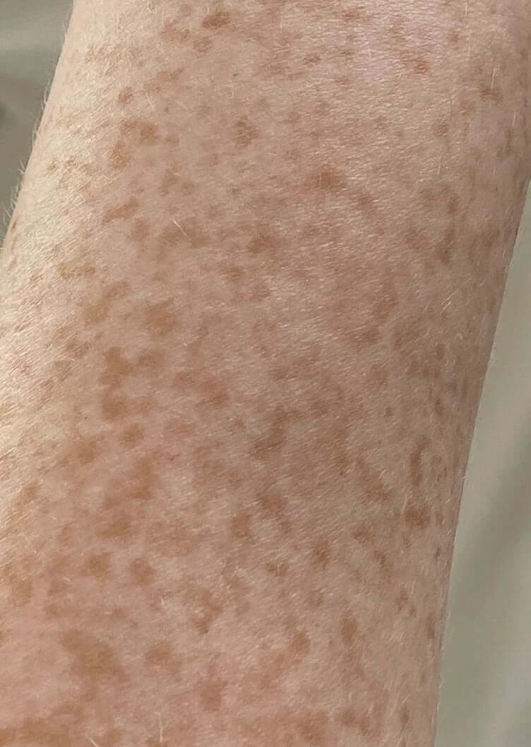 pigmentaiton treatment oil for fading freckles 