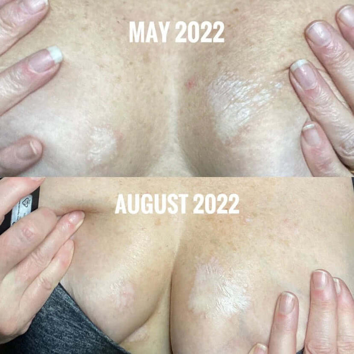 boob job after care treatment scare oil