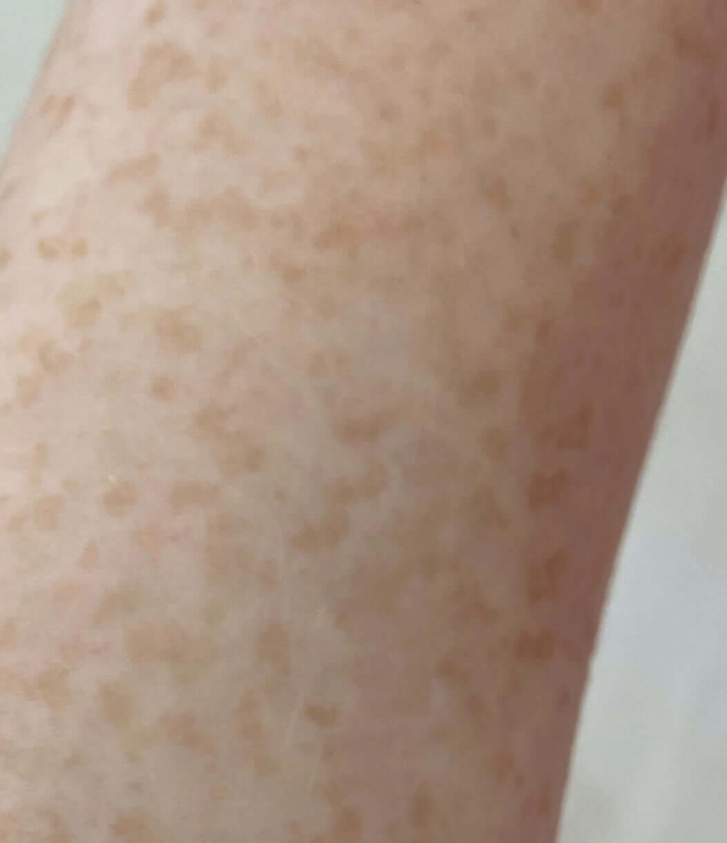 Fading freckles and dark spots skin care serum