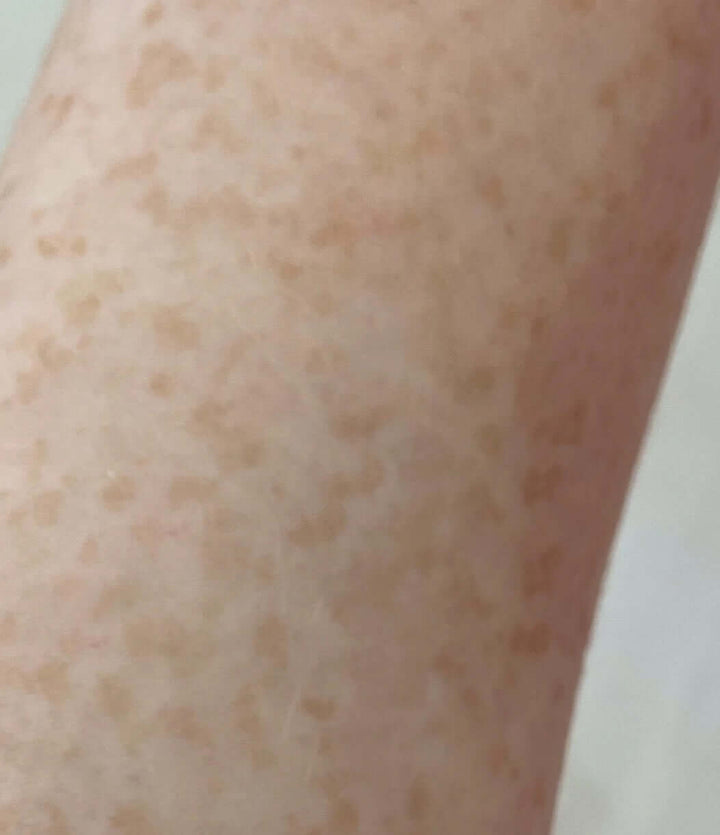 Fading freckles and dark spots skin care serum