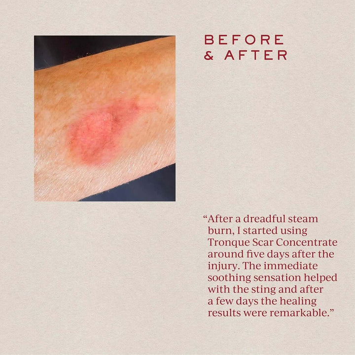 Scare treatment for burns cruelty free skin care